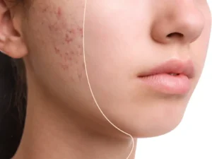 Acne Package